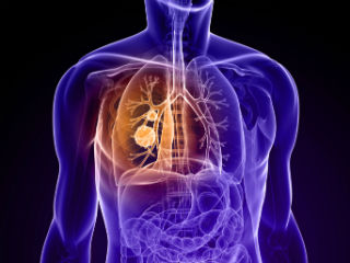 Transplantasi paru-paru ganda menyelamatkan pria AS dengan kanker stadium akhir GMA News Online
